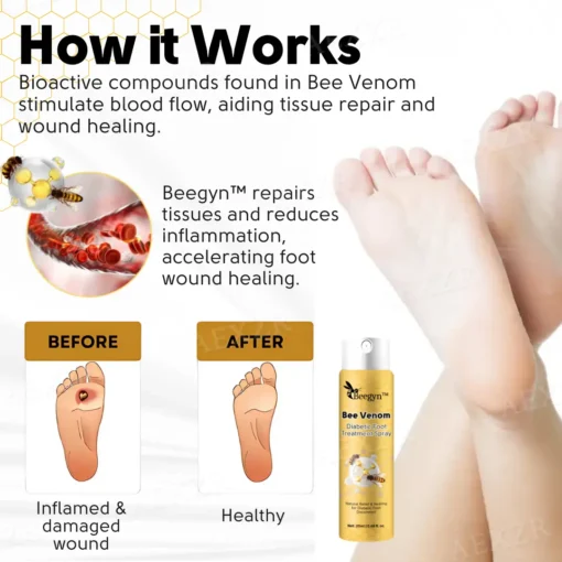 Beegyn™ Bee Venom Diabetic Foot Treatment Spray